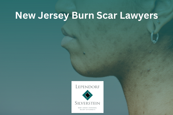 New Jersey Burn Scar Lawyers